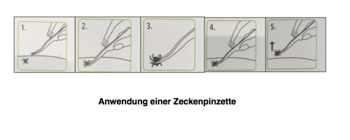 拨取蜱的方式图一 Zeckenpinzette